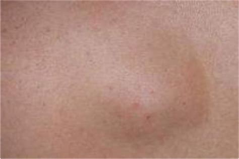 This causes large, red, pus-filled inflamed acne that's sore to the touch and long-lasting. . Cyst on butt cheek